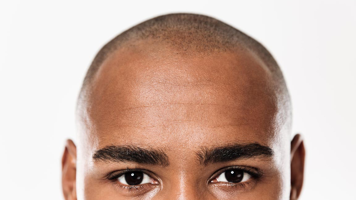 Afro Hair Transplant