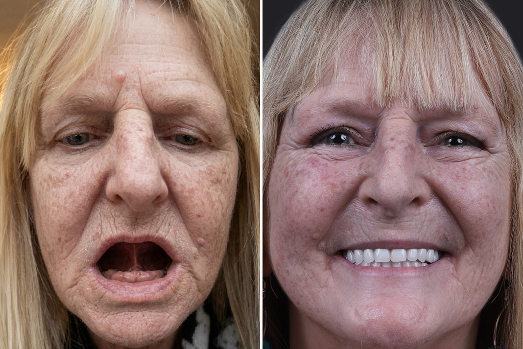 Dental-Implants