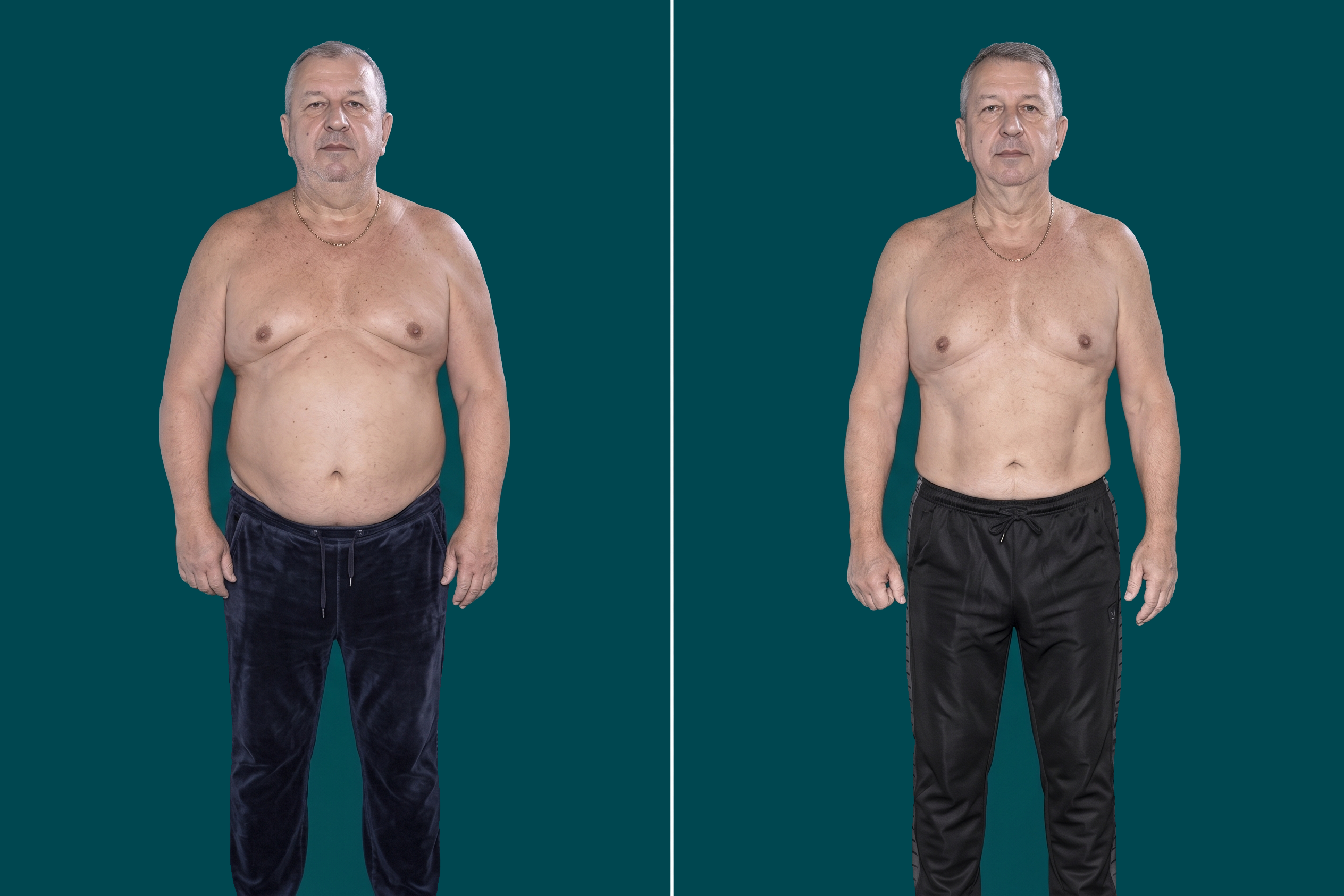Weight Loss Surgery-Gastric Bypass 1