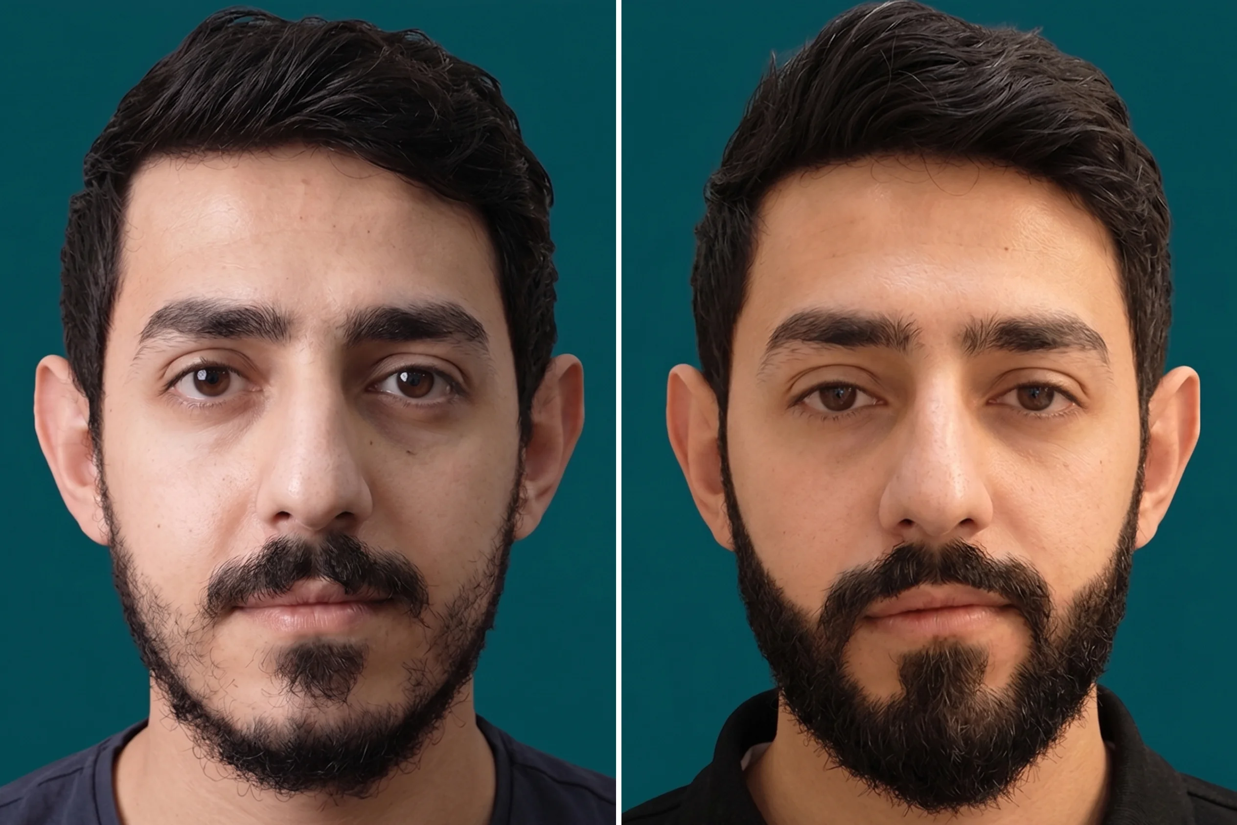 Beard Transplant 2