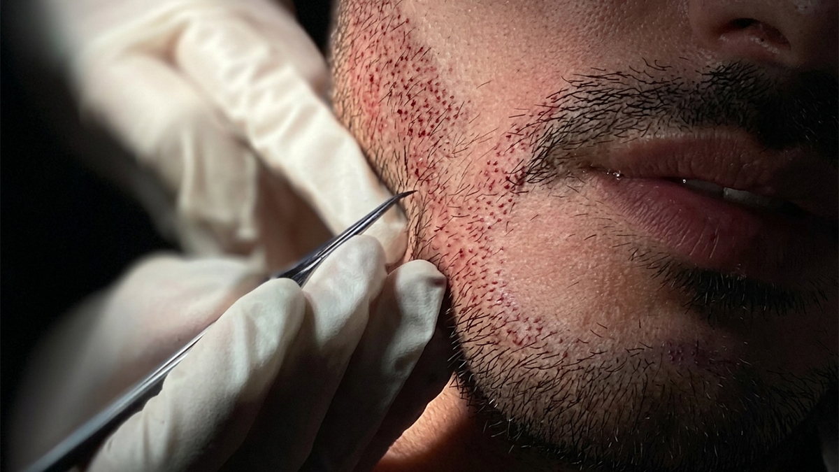 Beard Transplant