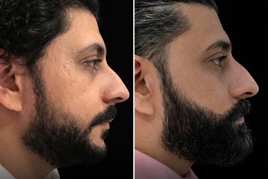 Beard Transplant Before After