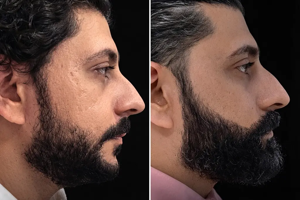 Beard Transplant Before After