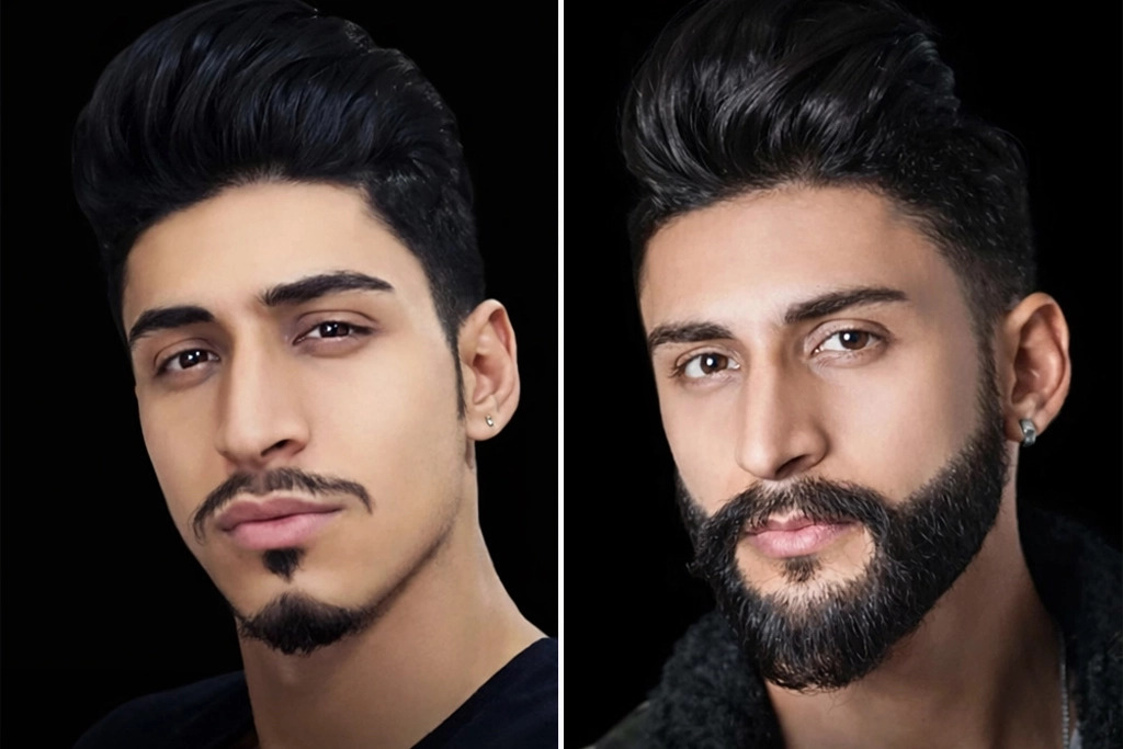 Beard Transplant 2