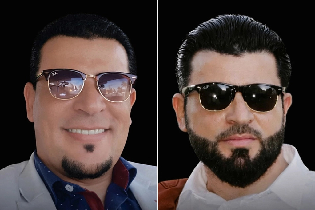 Beard Transplant Before After 2
