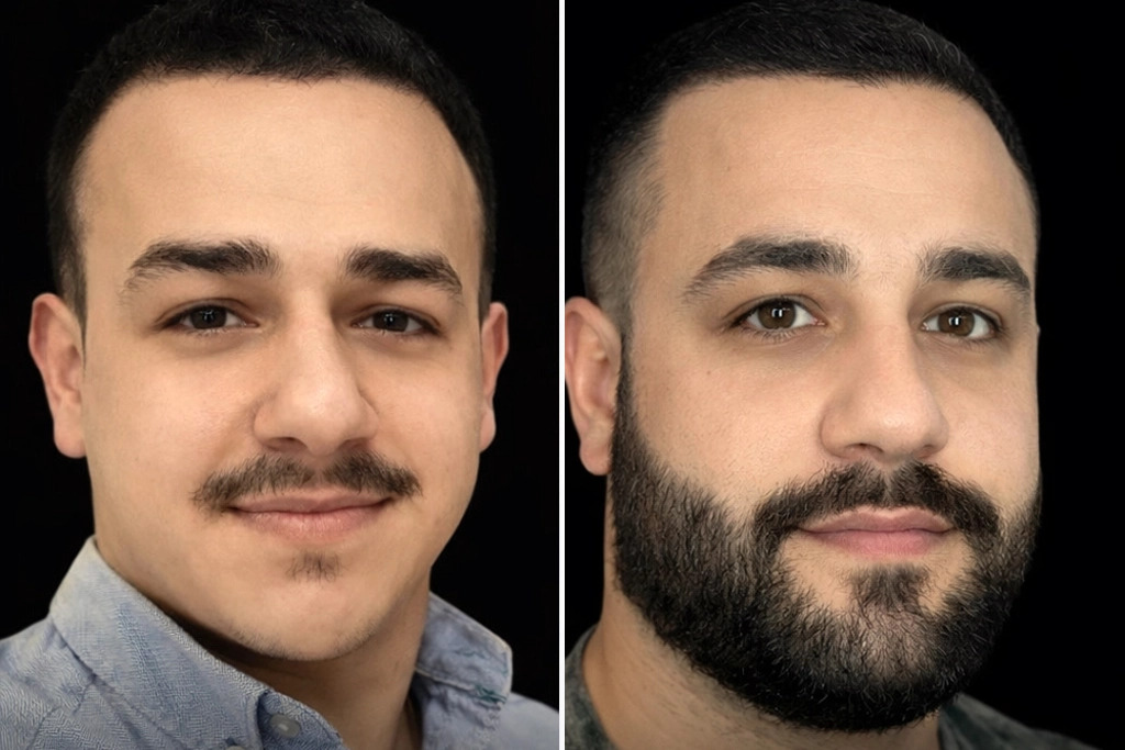 Beard Transplant 4