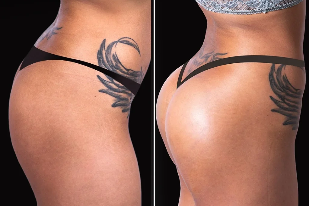 Brazilian Butt Lift - BBL 1