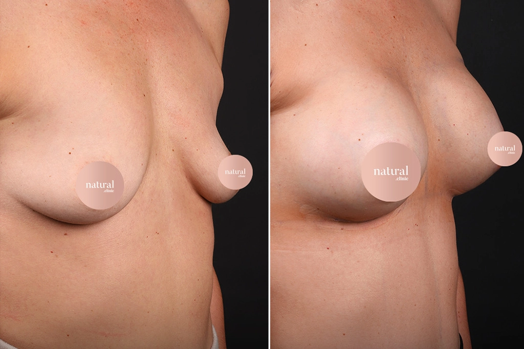 Breast Augmentation
