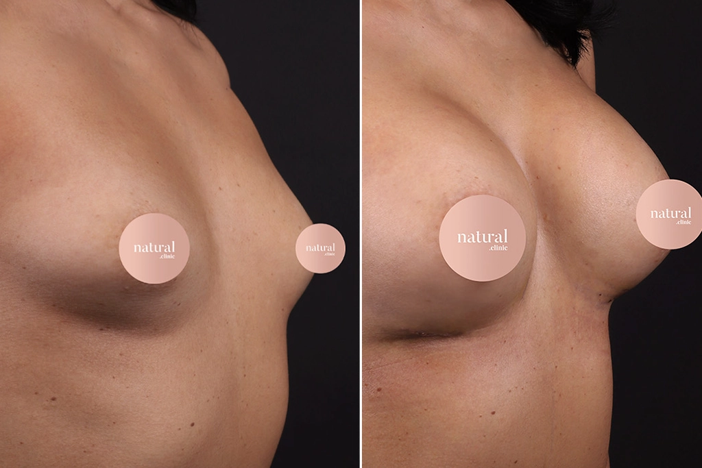 Breast Augmentation