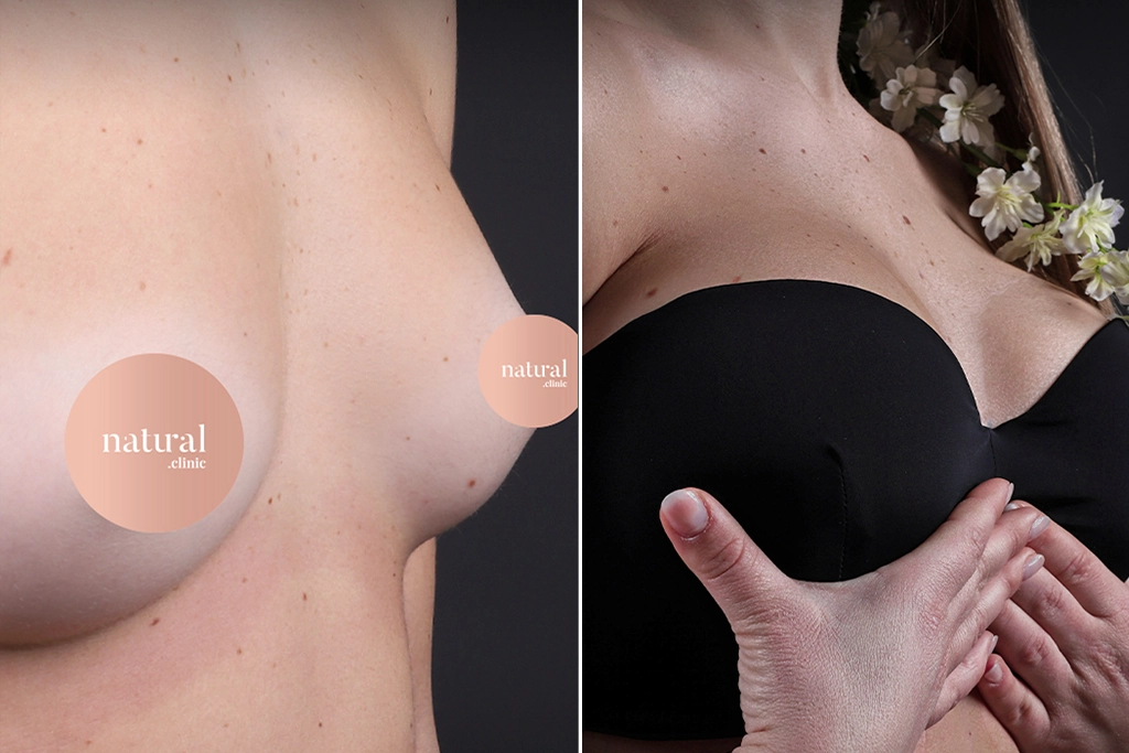 Breast Augmentation