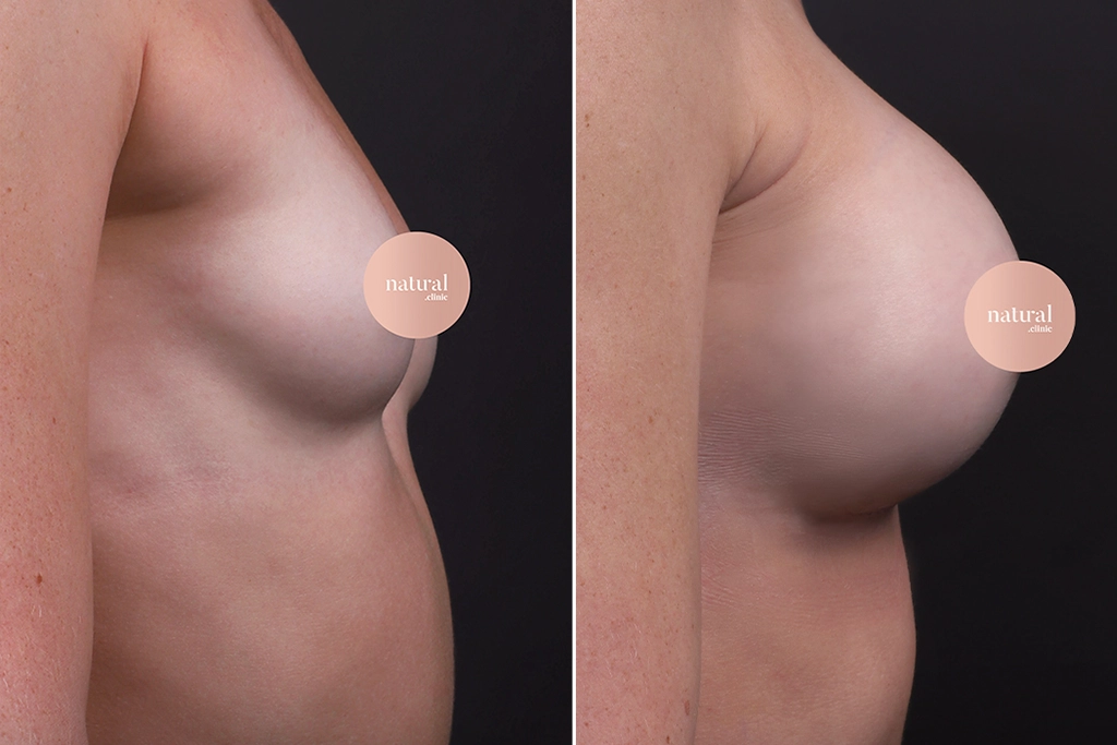 Breast Augmentation