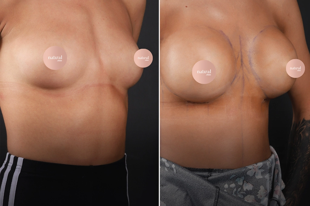 Breast Augmentation 