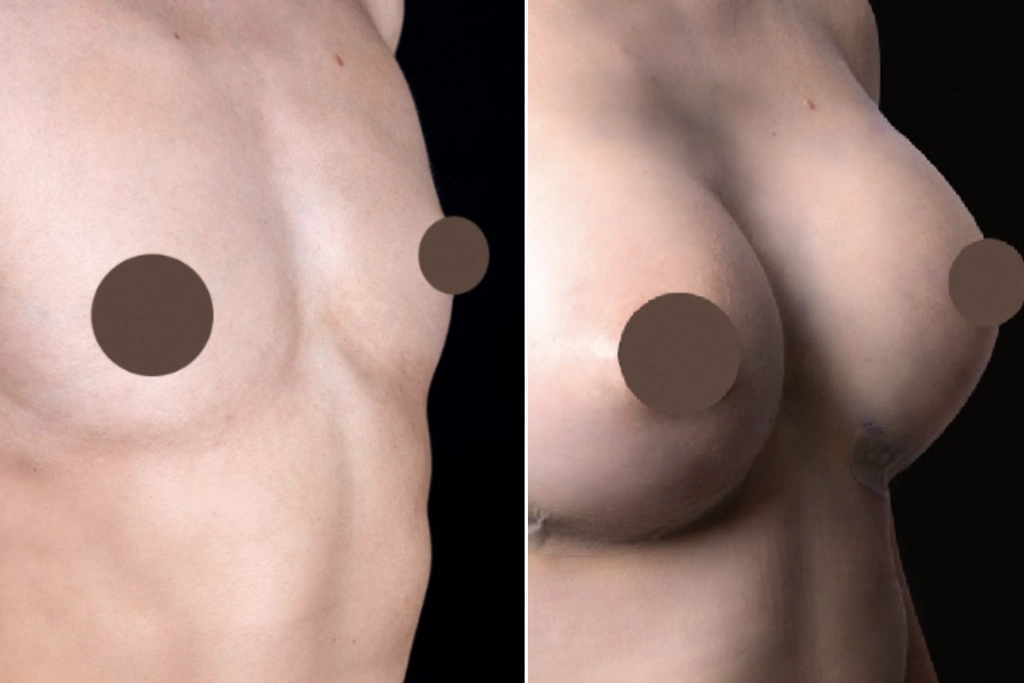 Breast Augmentation 