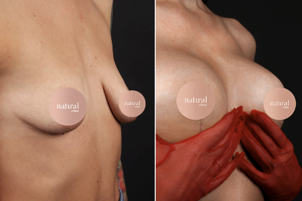 Breast Augmentation 