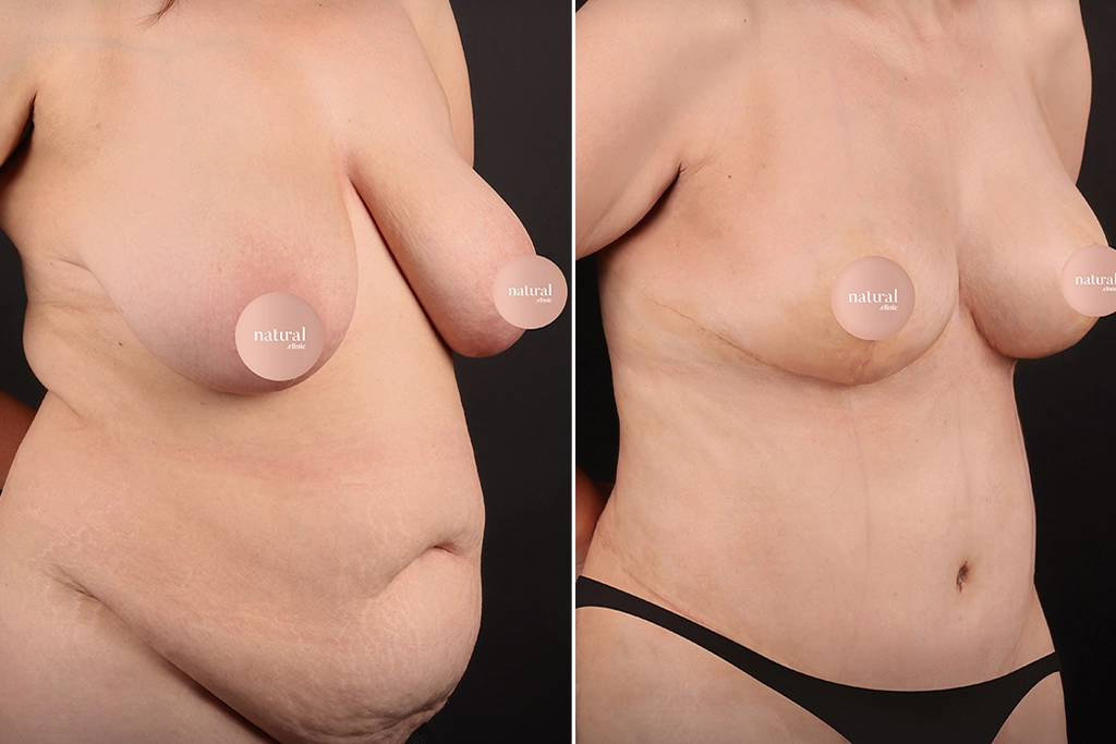 Breast Augmentation 