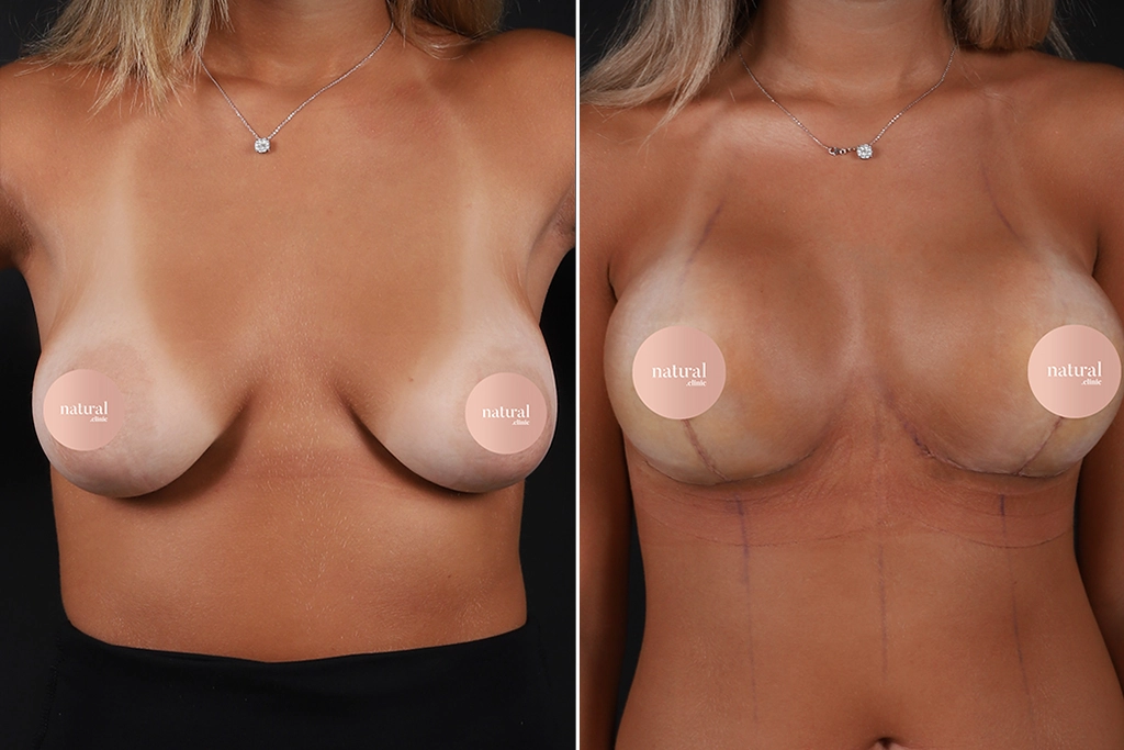 Before treatment