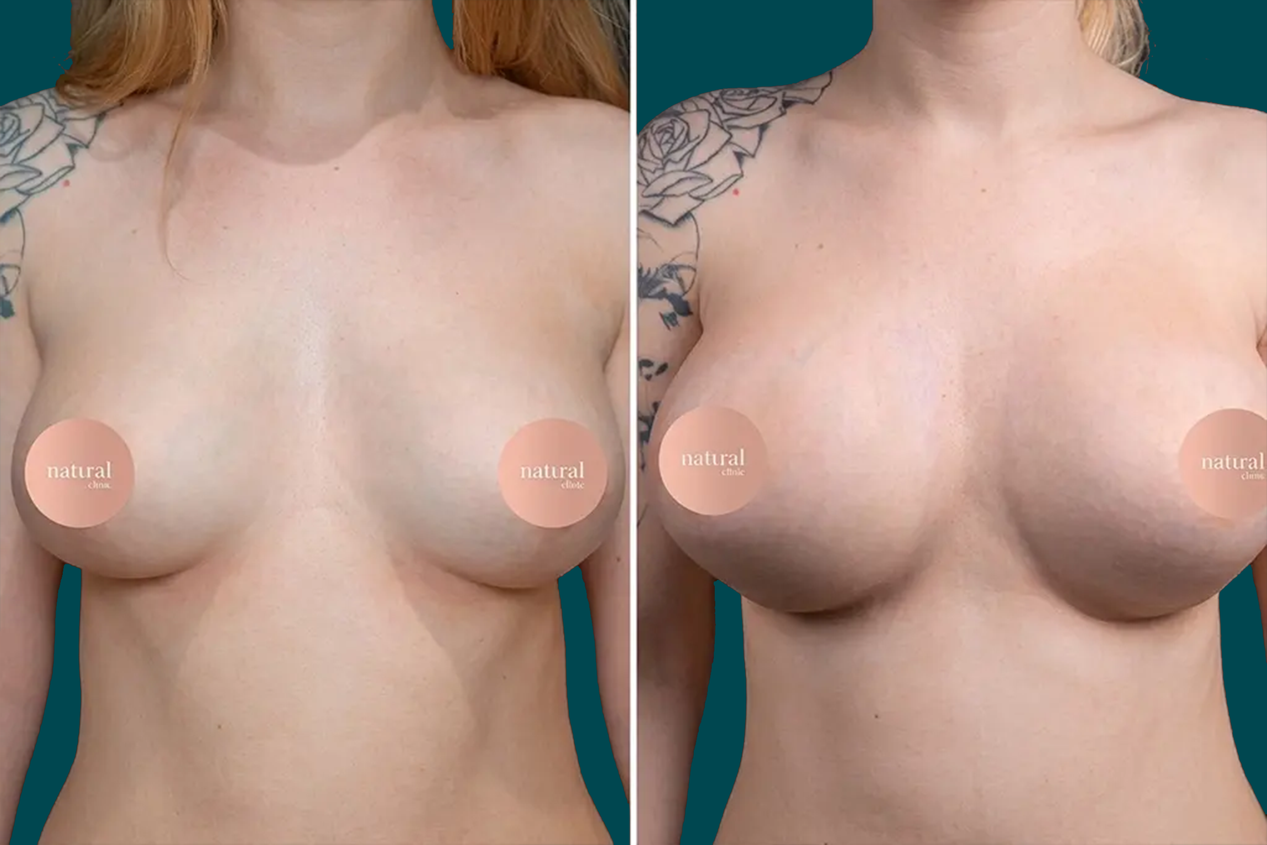 Breast Lift Before and After 3