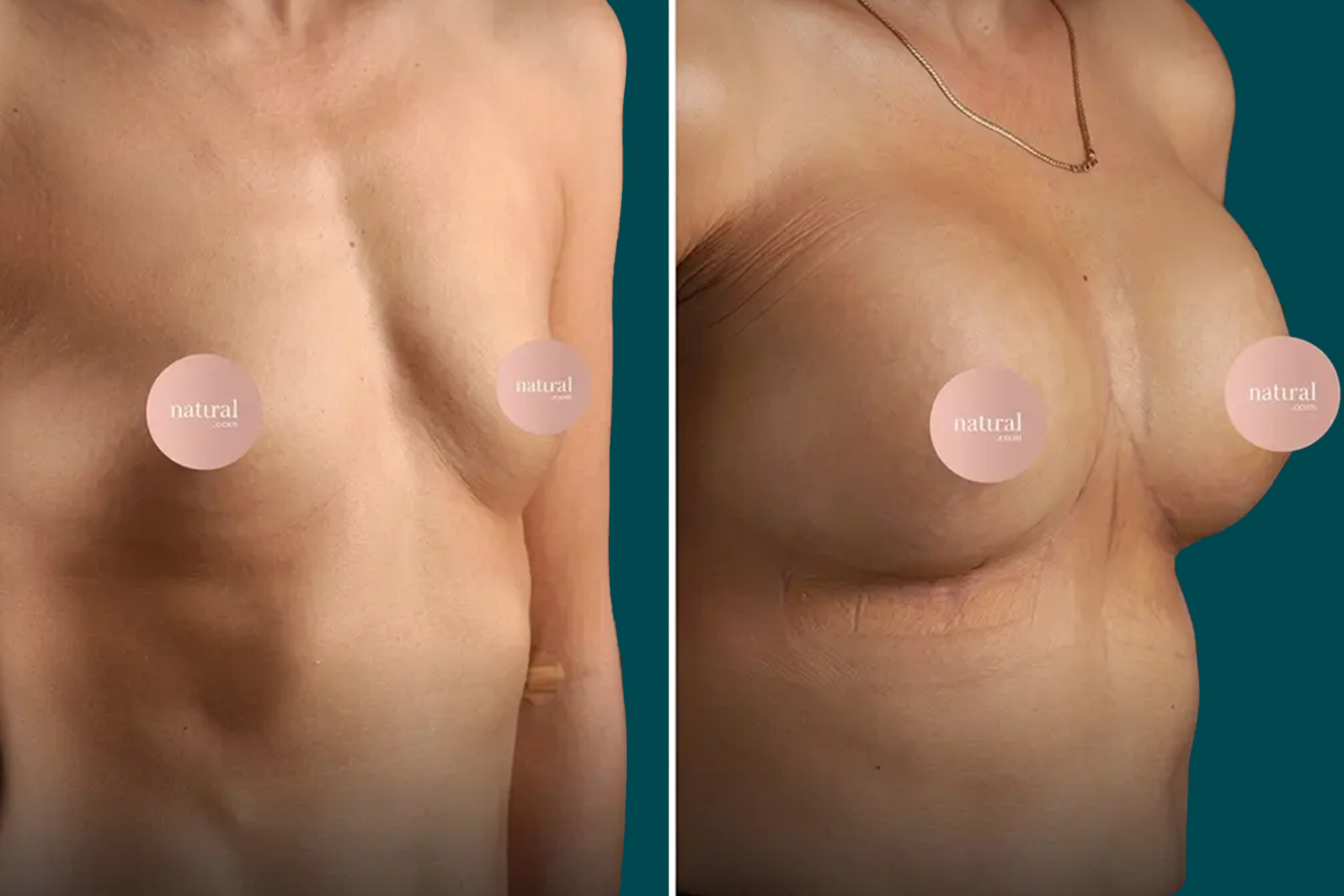 Breast Lift Before and After 4