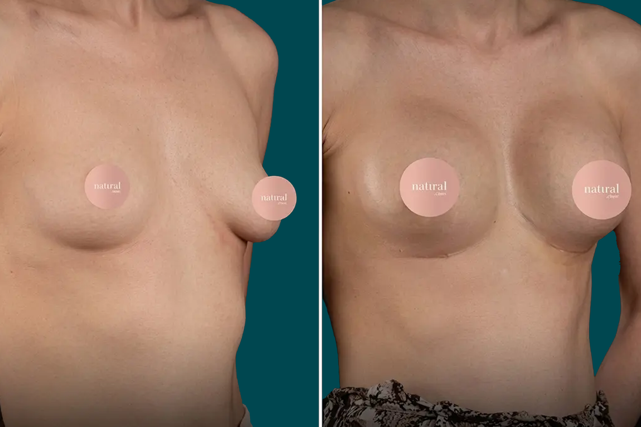 Breast Lift Before and After 5
