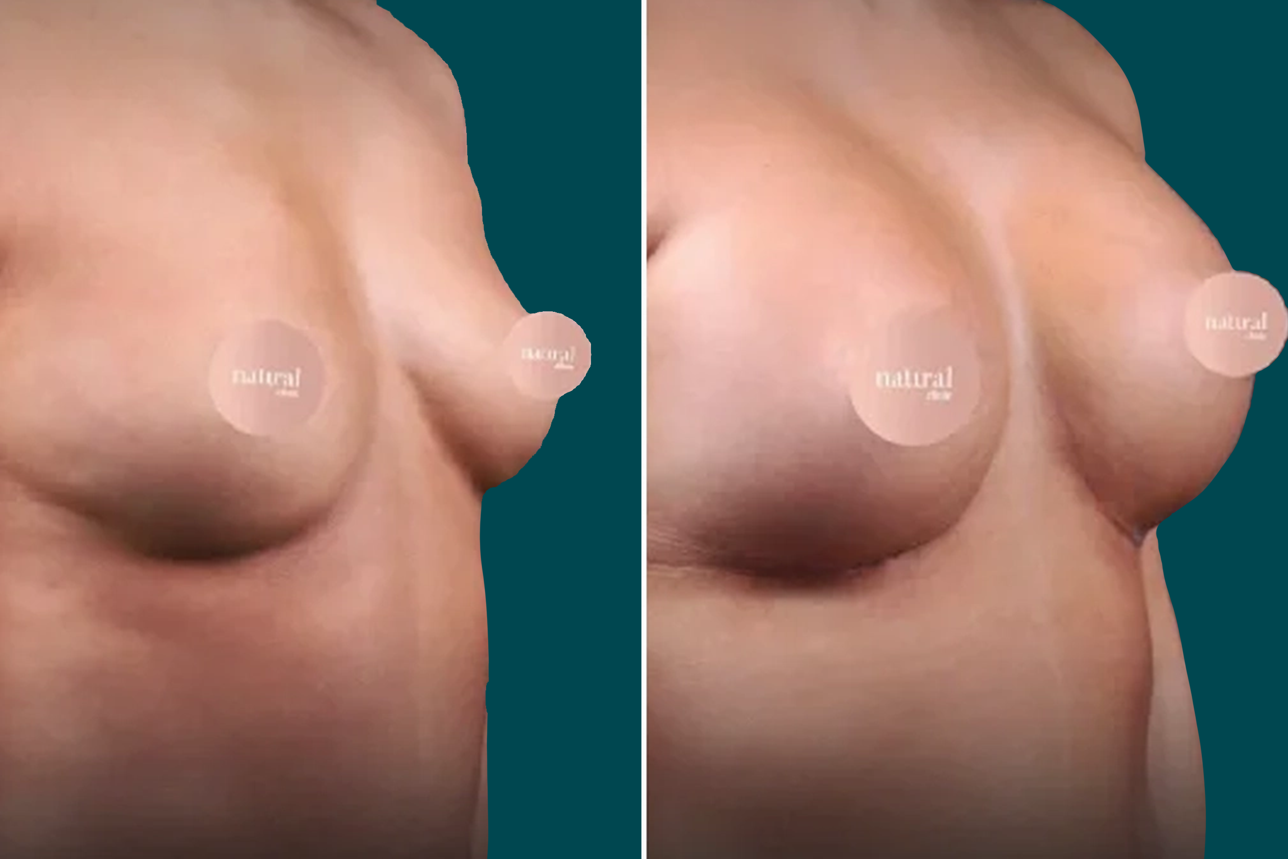 Breast Lift Before and After 9