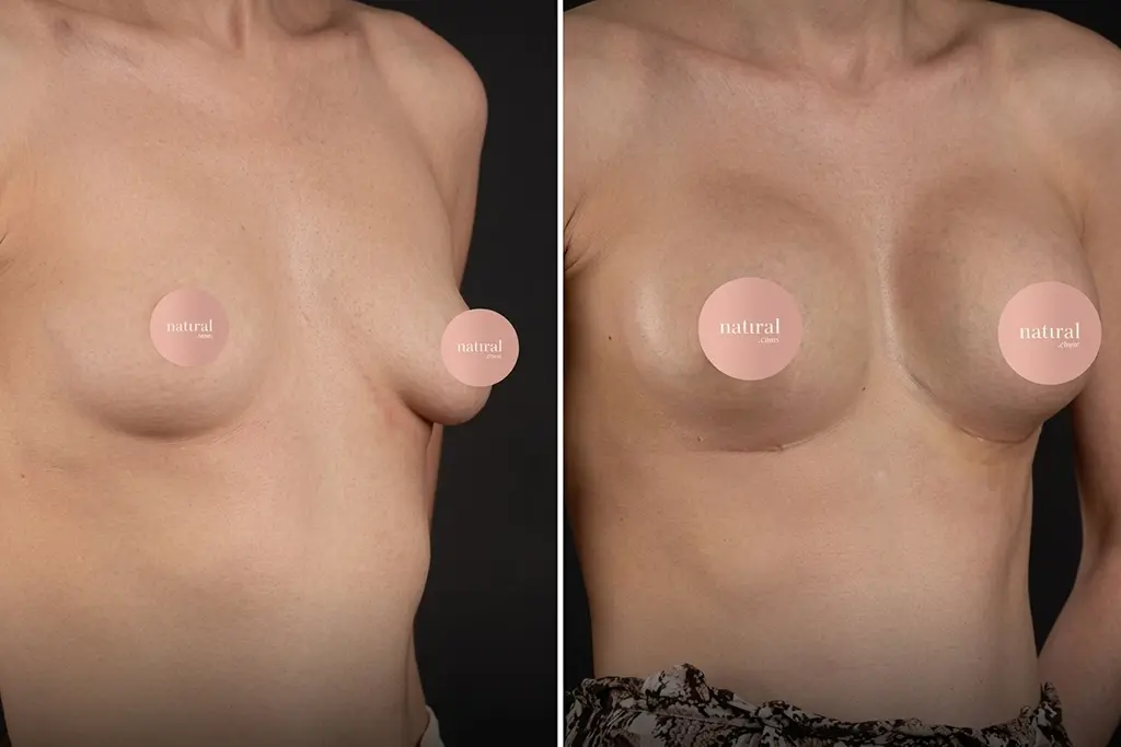 BreastLifting7