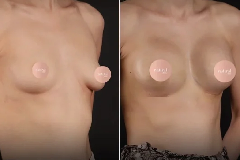 BreastLifting1