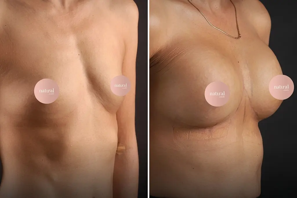 BreastLifting2
