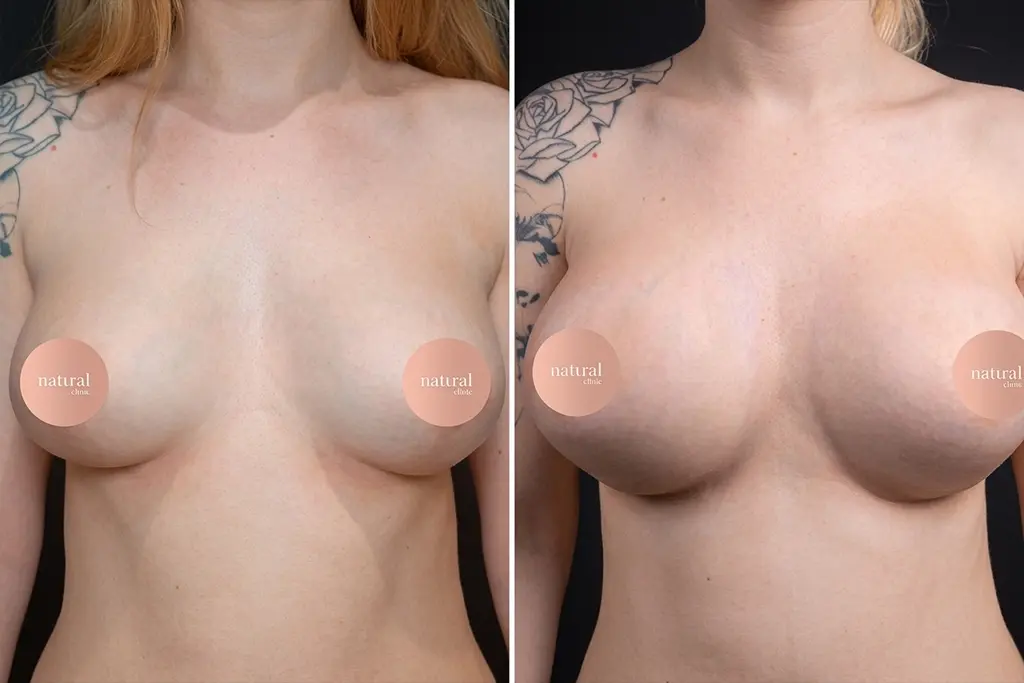 BreastLifting3