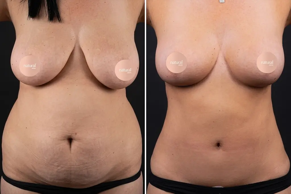 Breast Lifting