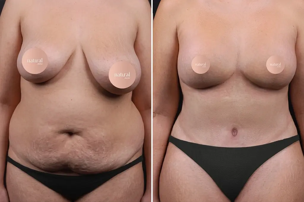 Breast Lifting