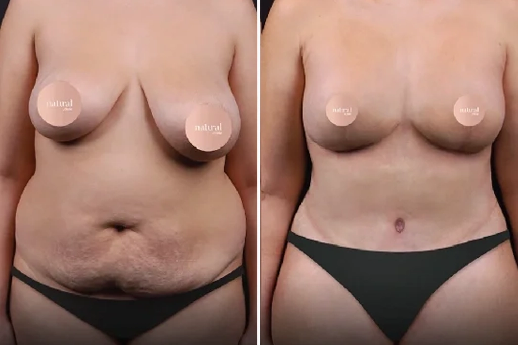 BreastLifting6