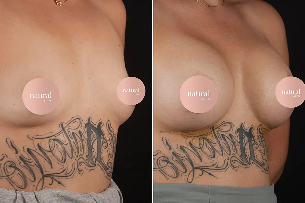 Breast Lifting