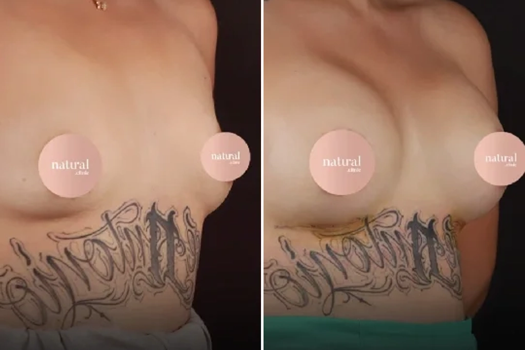 BreastLifting7