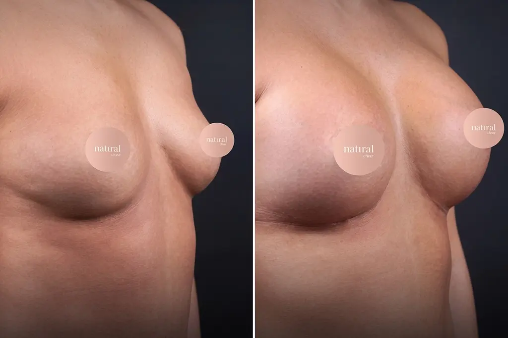 Breast Lifting 