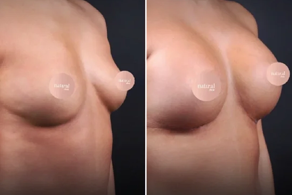BreastLifting8