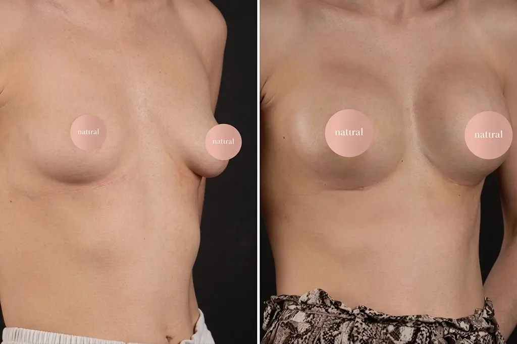 Breast Lifting 