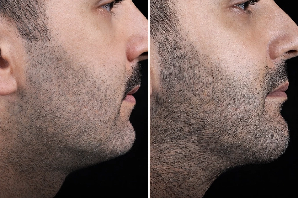 ChinLiposuction3