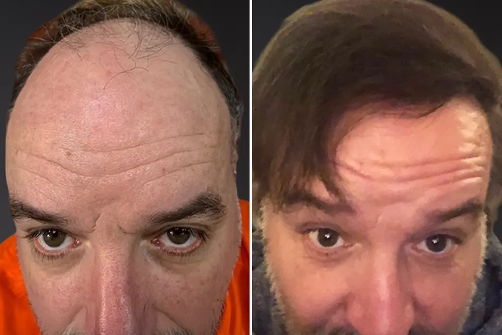 DHI Hair Transplant before after 3
