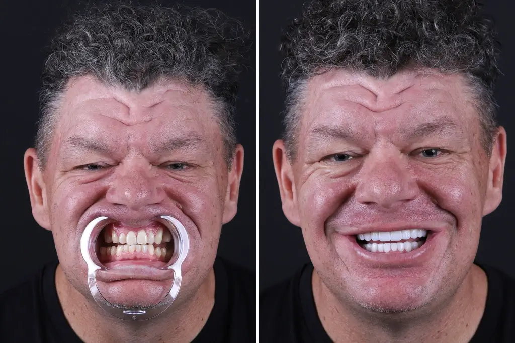Dental-Bridge