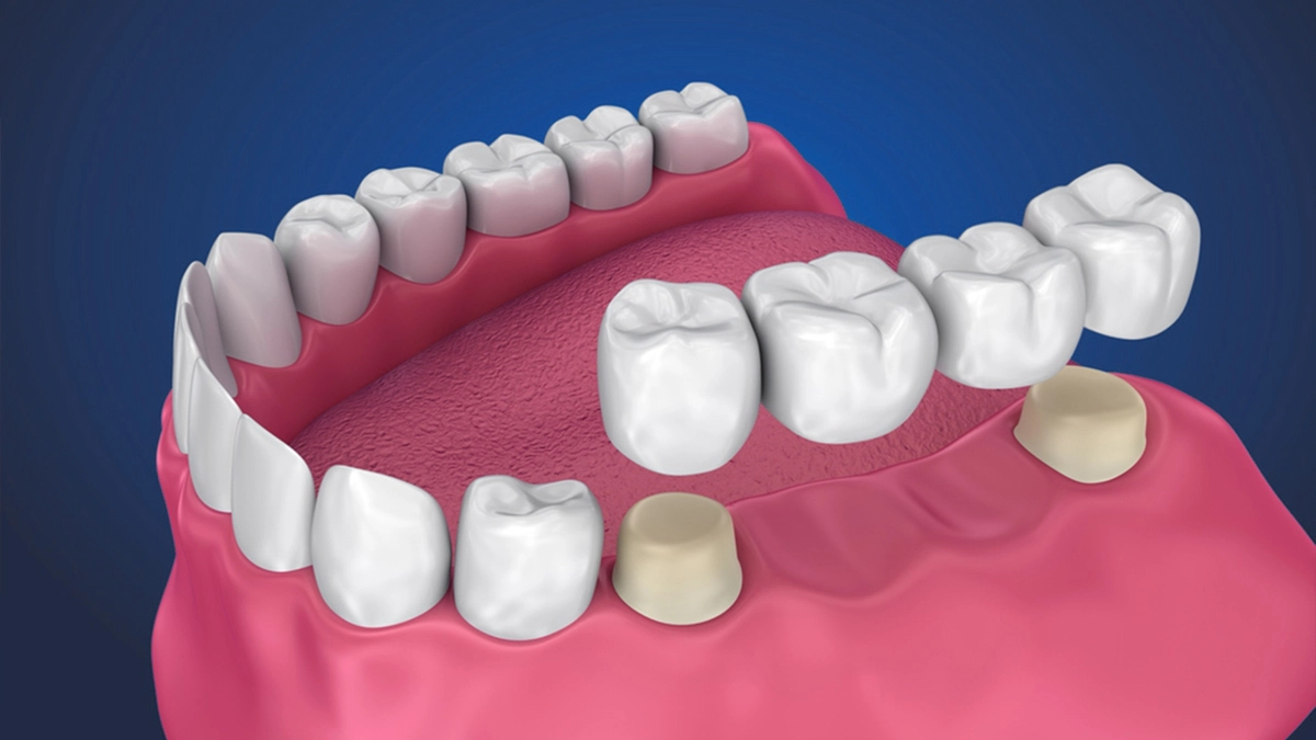 Dental-Bridge