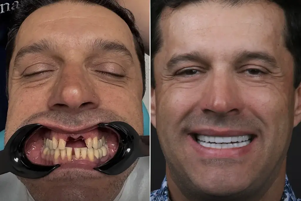 Dental-Bridge