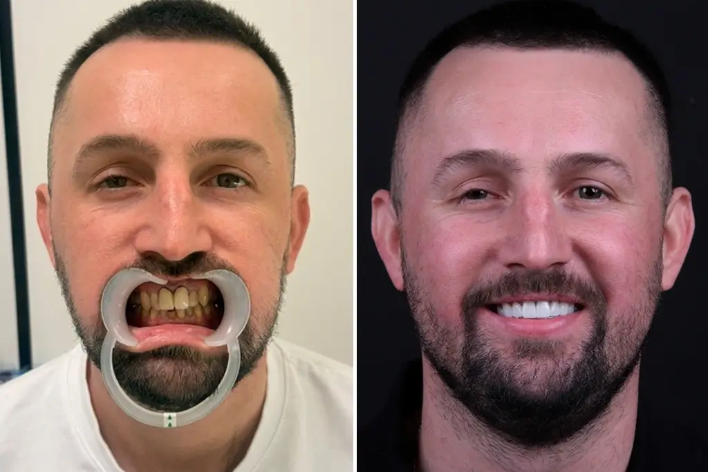 Dental-Crowns
