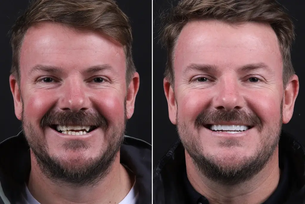 Dental-Crowns