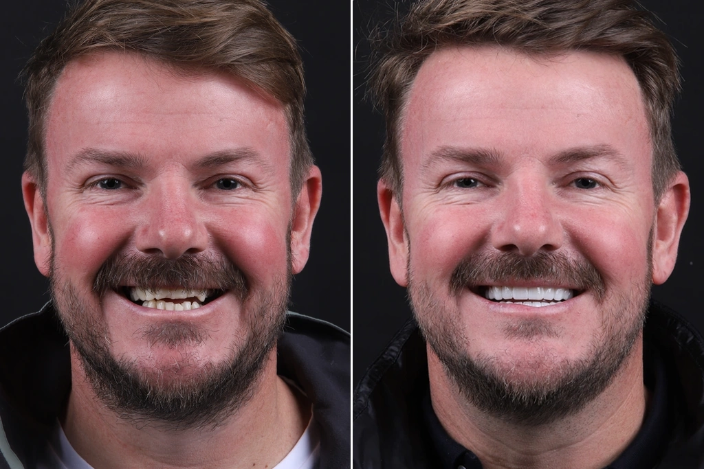 Dental-Crowns