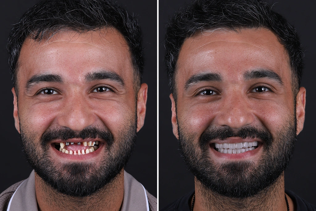 Dental-Implants