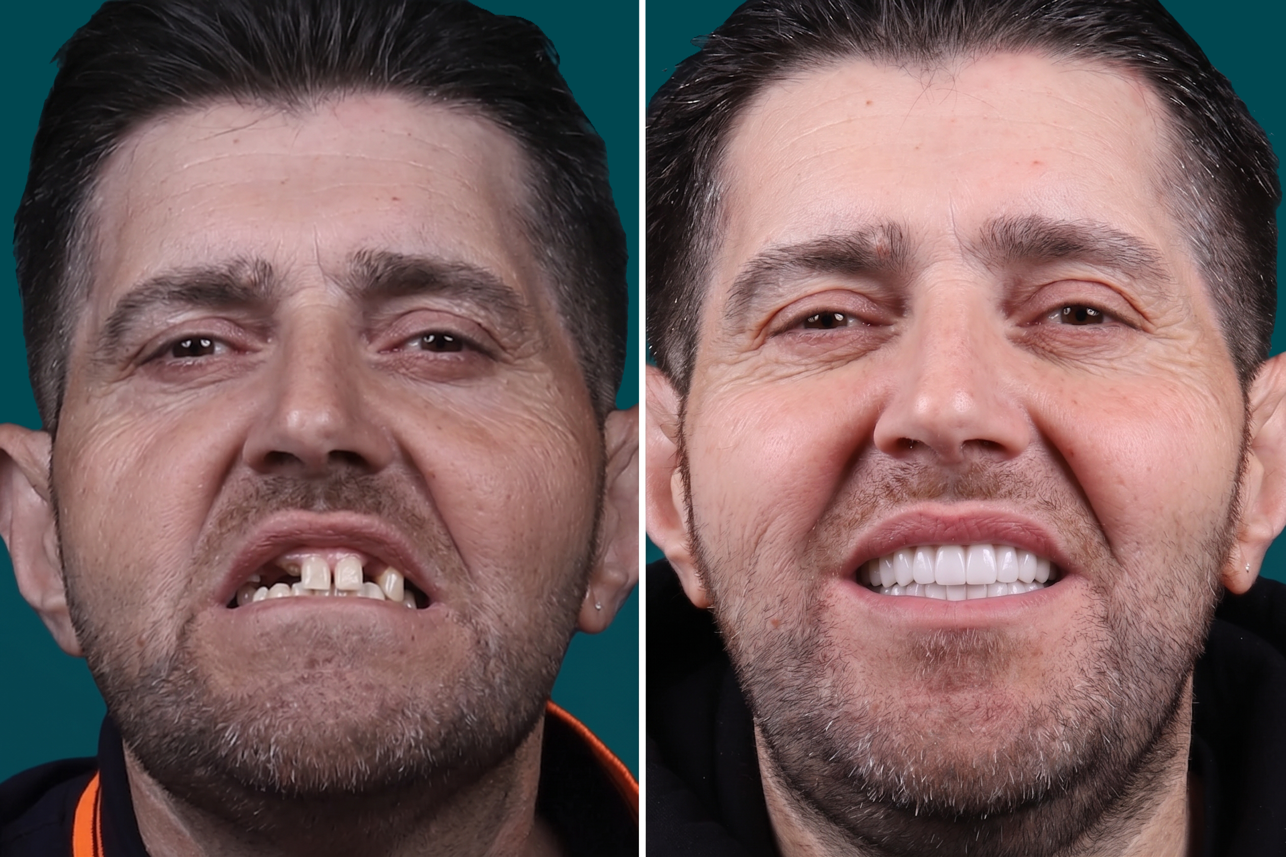 Dental-Implants 3