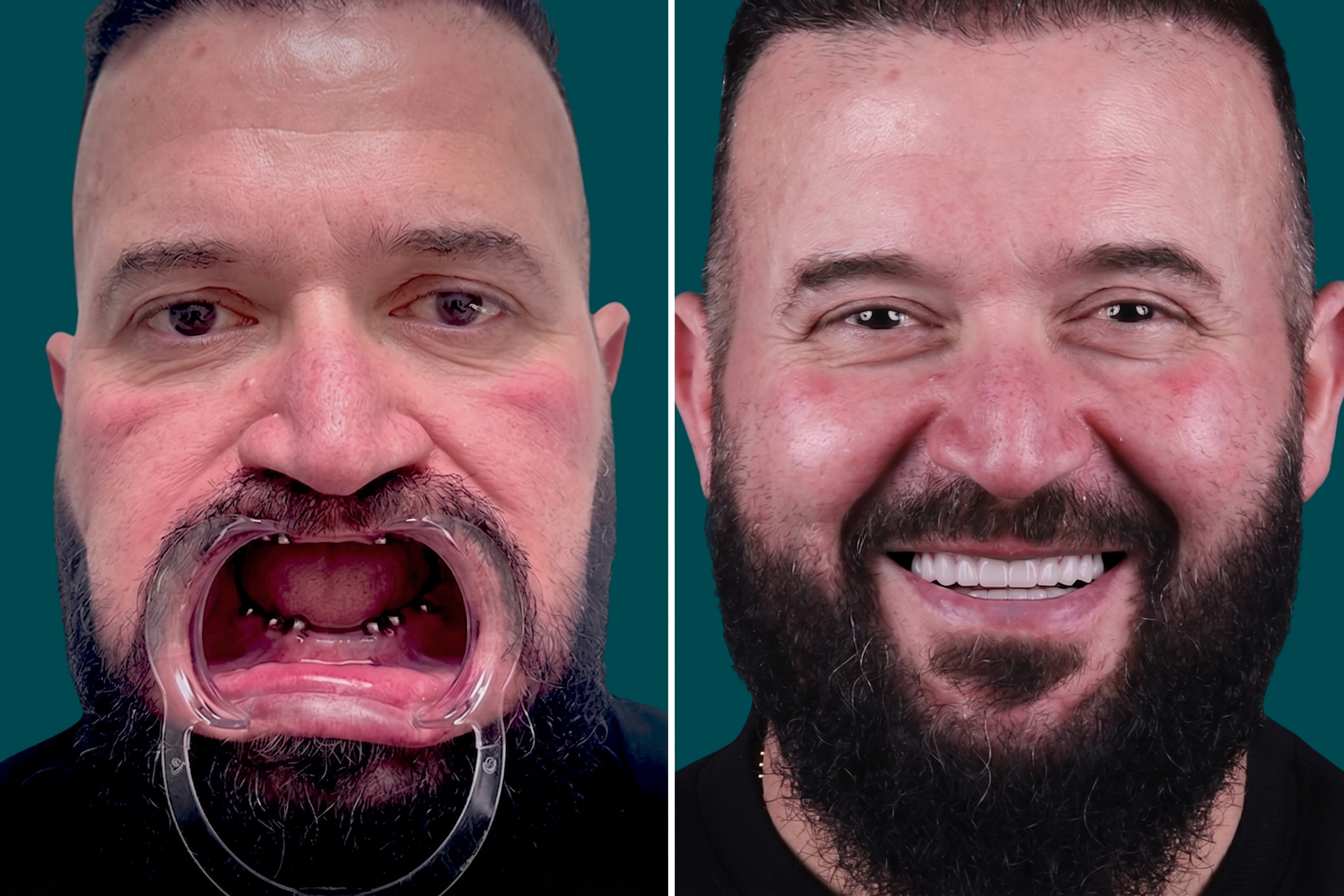 Dental-Implants 7