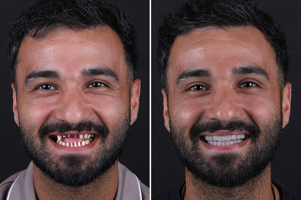 Dental-Implants