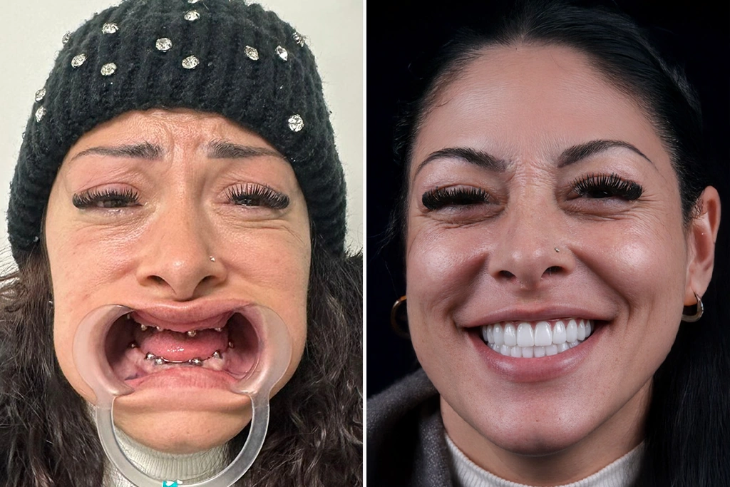 Dental-Implants