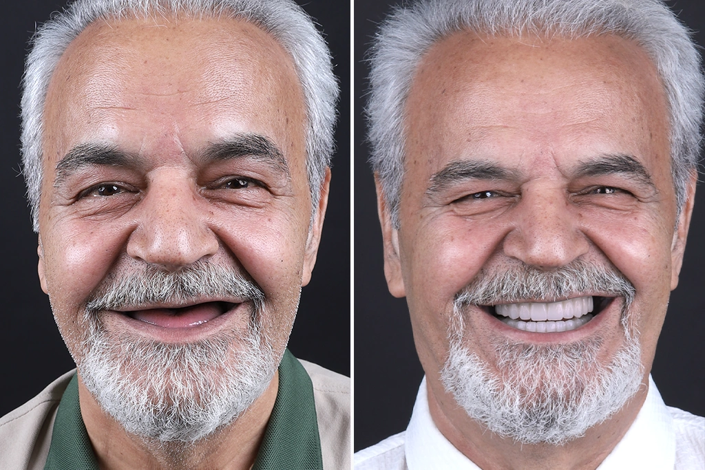 Dental-Implants